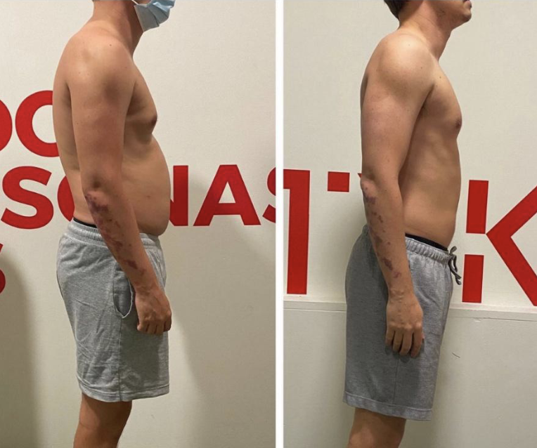 Adiós a la cifosis y -7 kg menos. Pablo Adiós a la cifosis y -7 kg menos. Pablo