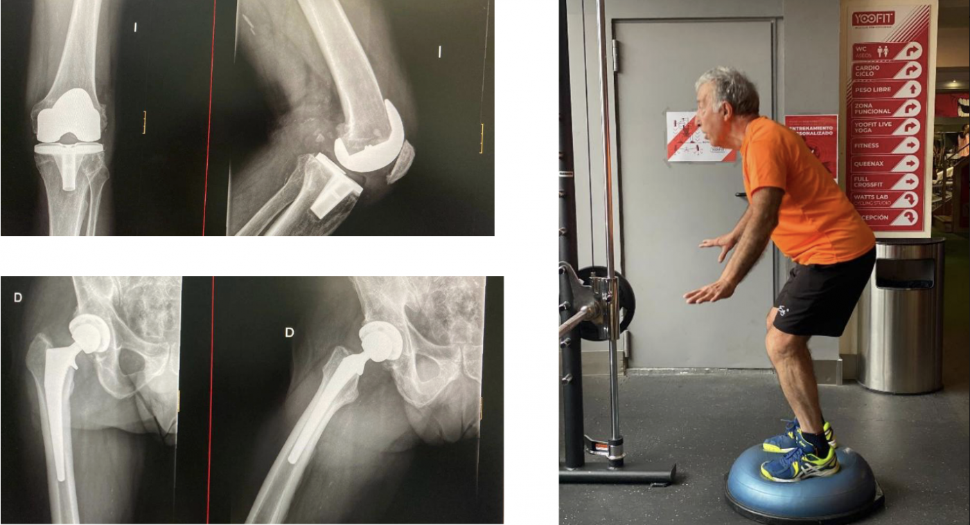 postural logramos aliviar sus molestias, mejorar la movilidad de sus hombros y devolverle la confianza en su espalda. Si tú también sufres dolores o limitaciones, empieza hoy a entrenar con nosotros y descubre cómo un trabajo bien planificado puede cambiar tu calidad de vida. De las prótesis a una vida activa. Agustín, postural logramos aliviar sus molestias, mejorar la<br />
movilidad de sus hombros y devolverle la confianza<br />
en su espalda.<br />
Si tú también sufres dolores o limitaciones, empieza<br />
hoy a entrenar con nosotros y descubre cómo un<br />
trabajo bien planificado puede cambiar tu calidad de<br />
vida.<br />
De las prótesis a una vida activa.<br />
Agustín,